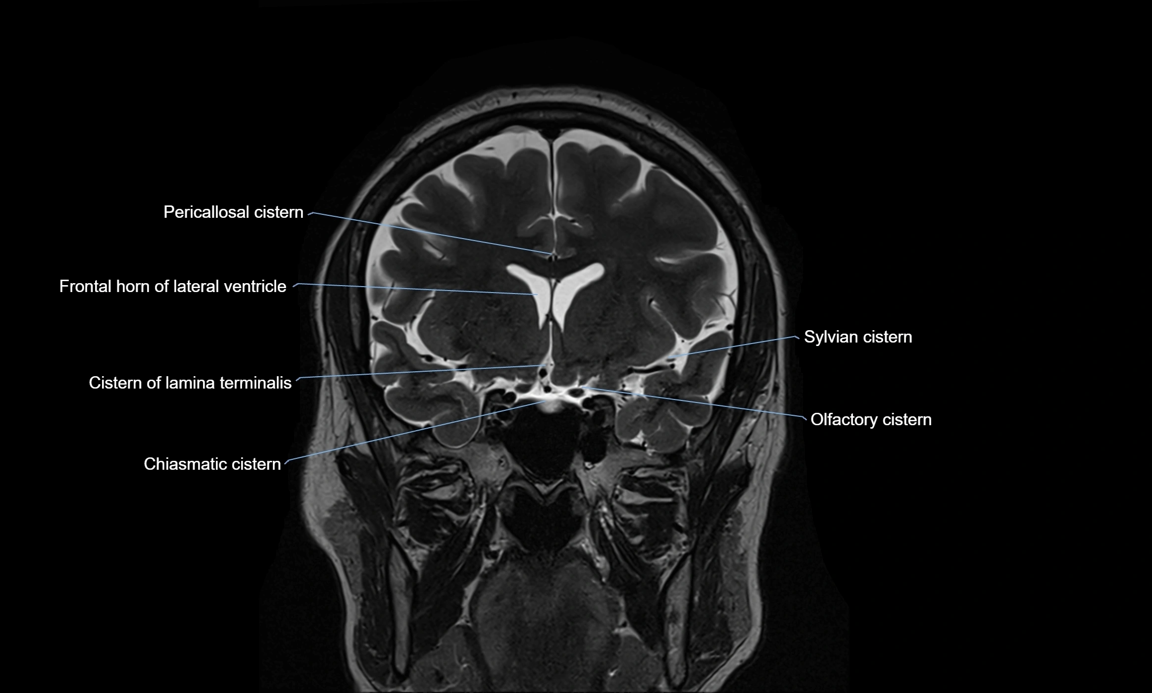 Brain cisterns  and ventricles coronal anatomy 3T MRI image-img-00001-00019.webp